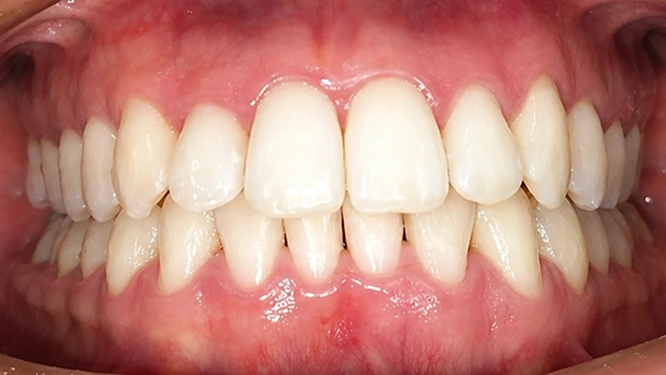 Después del tratamiento Invisalign: dientes alineados y sonrisa corregida